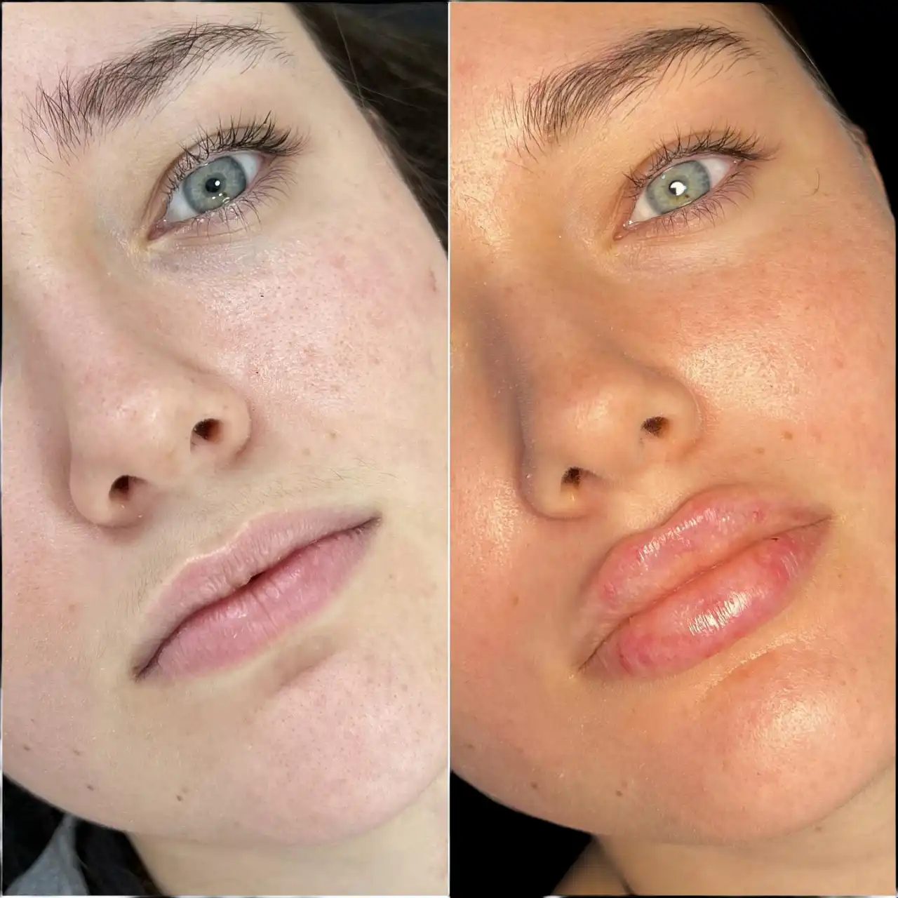 Best Doctors in Dubai for Fillers for Beautiful, Natural Results - Newsglo Fillers in Dubai