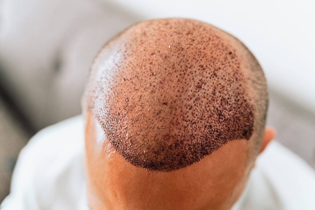 Hair Transplant in Dammam