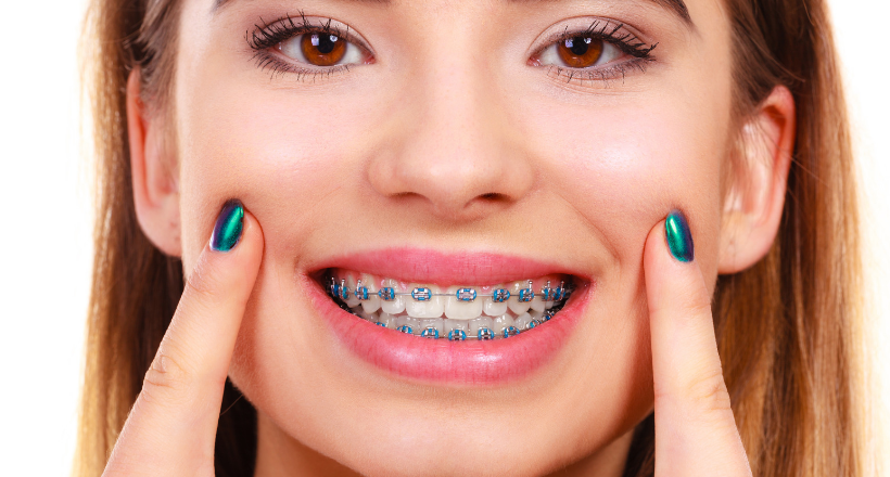 How Dental Braces Create a Perfect Smile