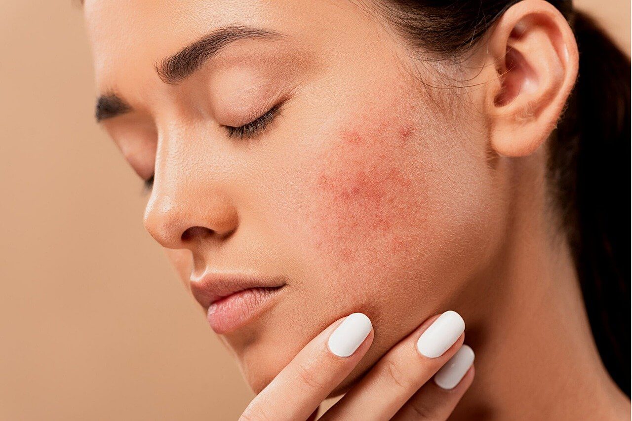 Get Rid Of Acne Naturally Using Ayurvedic Skin Care
