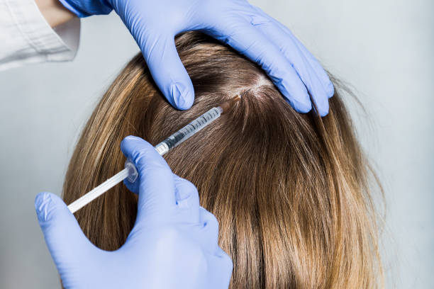 PRP Hair Treatment in Riyadh