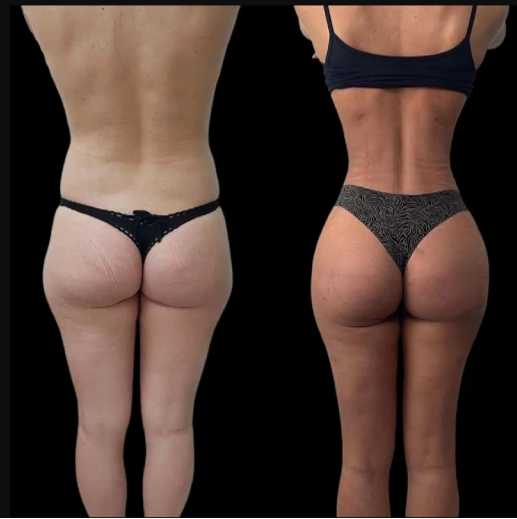 A Complete Guide to J-Plasma by the Best Plastic Surgeons in Dubai - Newsglo