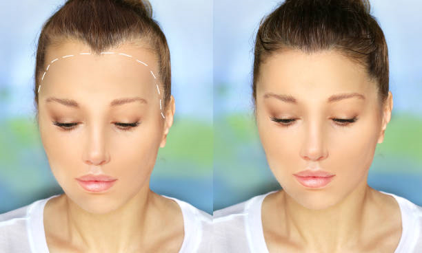 Stem cell Hair Transplant in Riydh