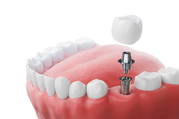 Are Dental Implants Painful or Comfortable