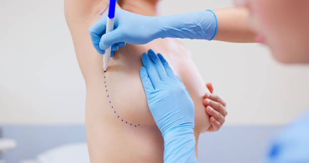 Are Mentor Breast Implants Safe and Long-Lasting