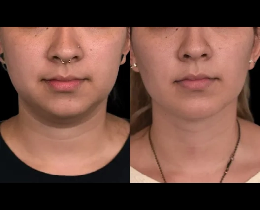 Double chin removal in Dubai