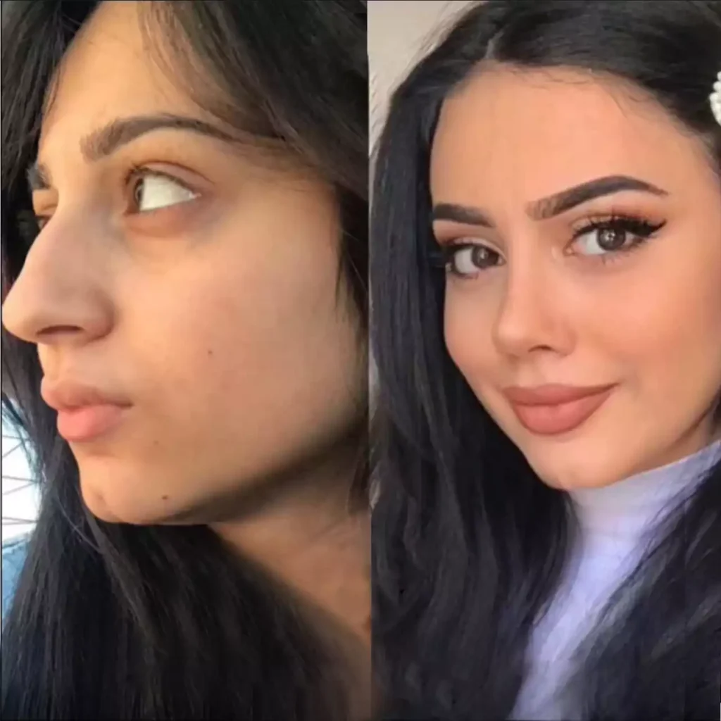 Rhinoplasty in Dubai