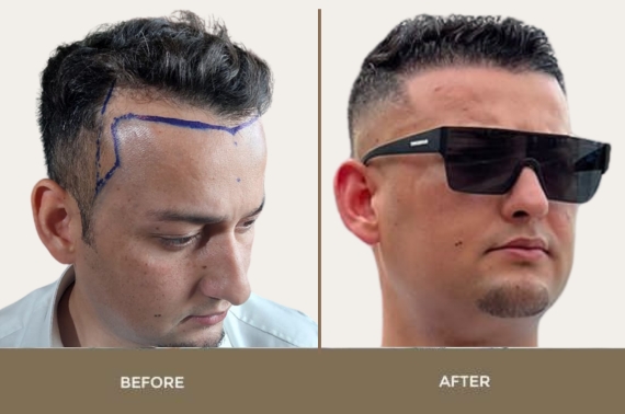 Best Hair Transplant in Pakistan