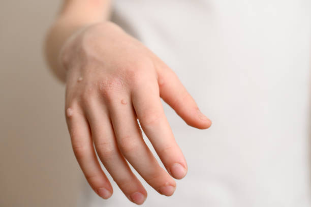 How Effective Is Warts Removal Treatment Today?