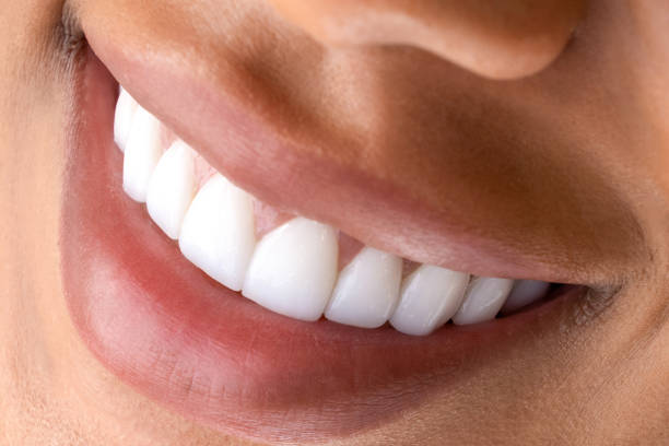 Is Teeth Whitening Safe for Sensitive Teeth