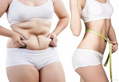 Liposuction in Riyadh