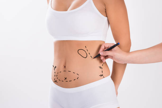 Liposuction in Riyadh