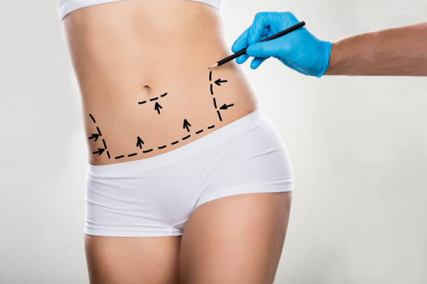Liposuction in Riyadh