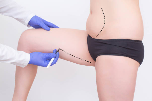 liposuction in Riyadh