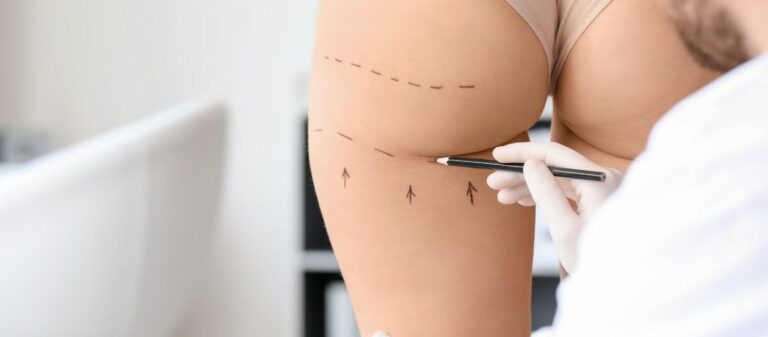 Safe and Effective Buttock Lift Procedures