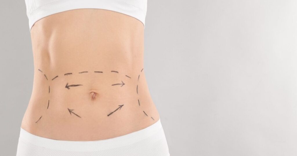 What to Expect During a Tummy Tuck Procedure