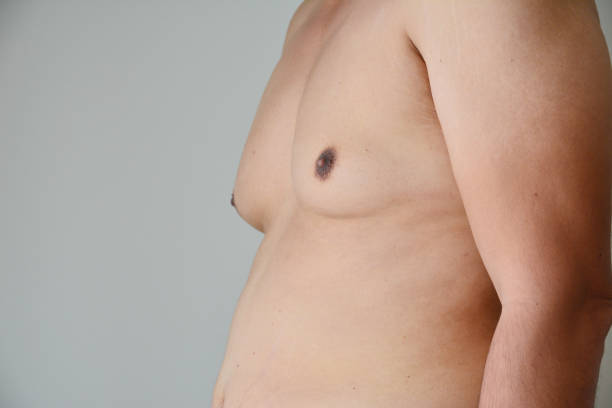 Why Do Men Choose Gynecomastia Surgery Today