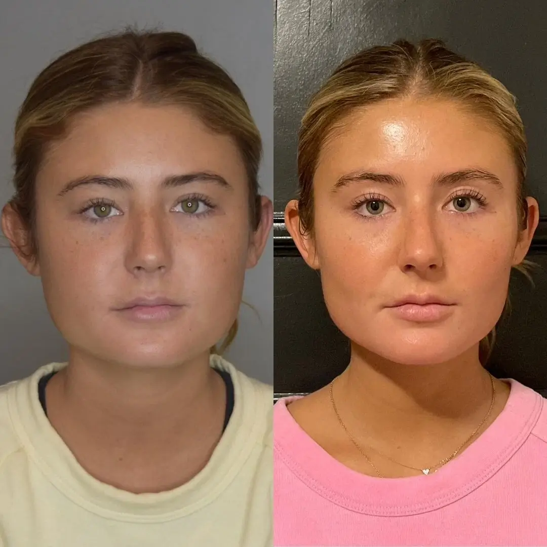 Buccal Fat Removal in dubai