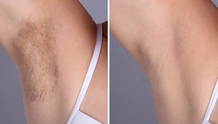 Proven Care by the Best Plastic Surgeon in dubai: laser hair removal - Newsglo Laser hair removal in Dubai