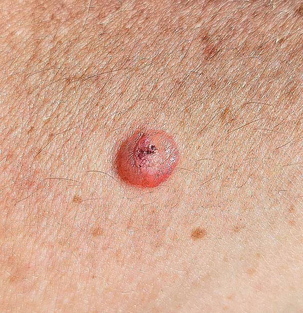 زالة الشامات في الرياض