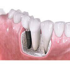 Removable Partial Dentures