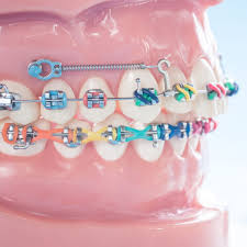 The Complete Invisalign Journey: What to Expect from Start to Finish - Newsglo The Complete Invisalign Journey: What to Expect from Start to Finish - Newsglo