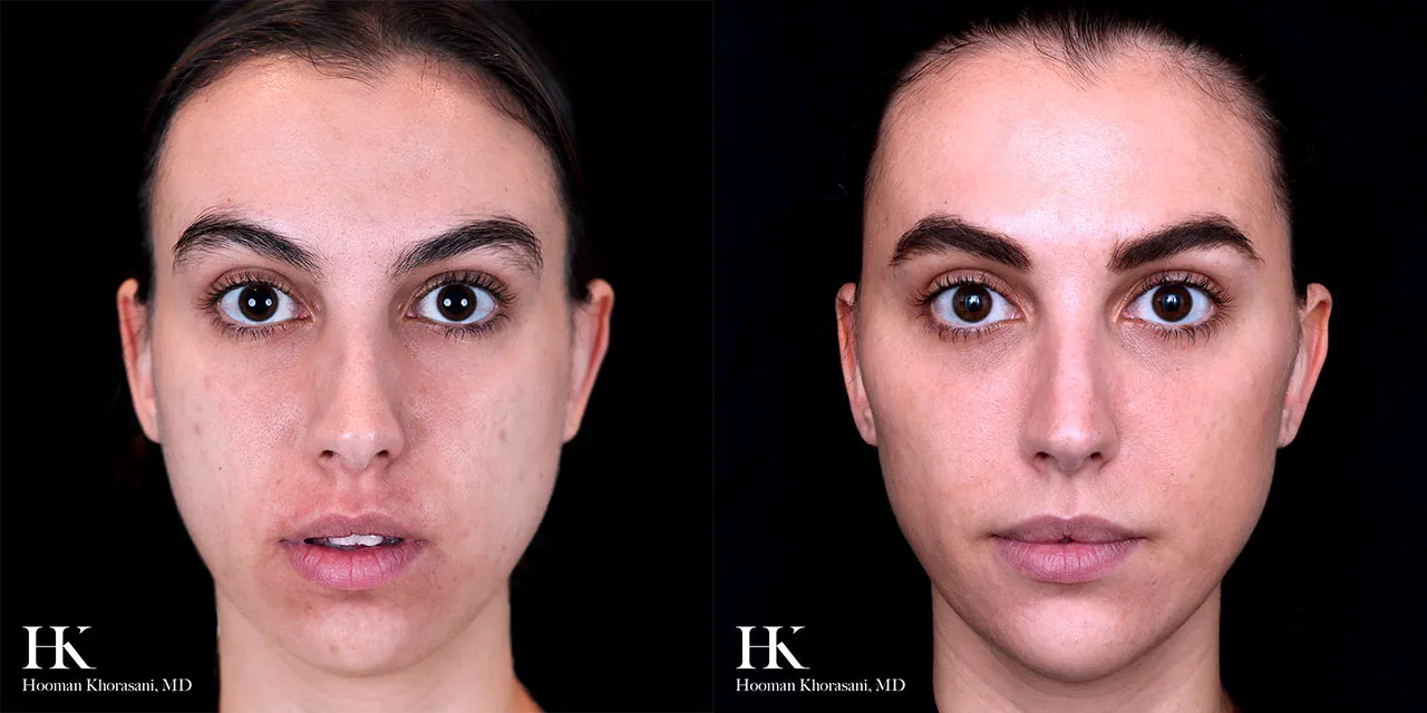 Why Women Start Forehead Wrinkles Treatment Earlier Than Men - Newsglo