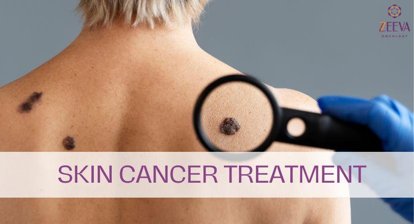 Best Skin Cancer Treatment in Noida