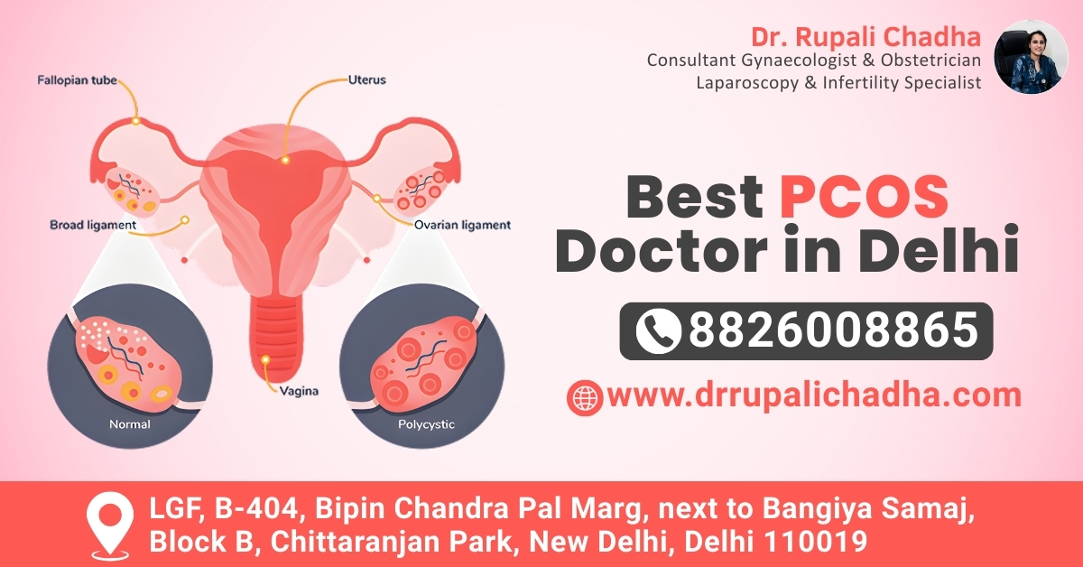 Best PCOS Doctor in Delhi – Expert Care for Hormonal Balance - Newsglo Best PCOS Doctor in Delhi