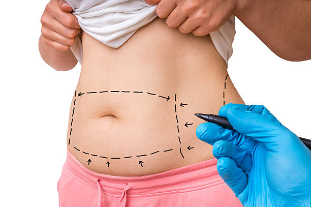Can Liposuction Remove Fat Diets Can’t