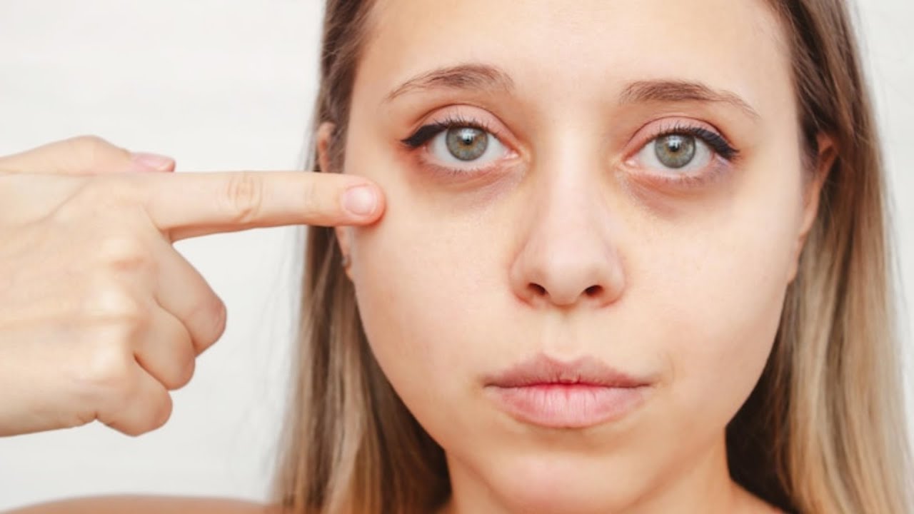Does Dark Circles Treatment Really Remove Under-Eye Shadows