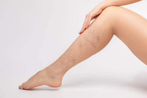 Does Sclerotherapy Really Remove Varicose Veins