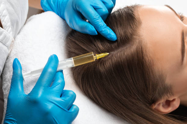 Does the Best PRP Hair Treatment Stop Balding