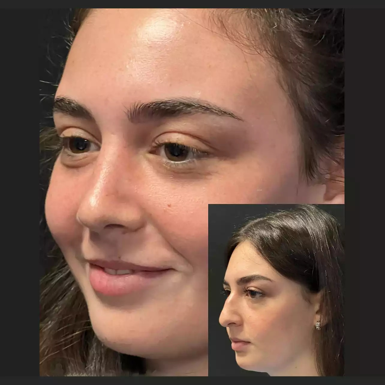 Best Rhinoplasty Surgeon in Dubai: Standards of Surgical Care - Newsglo Rhinoplasty in Dubai