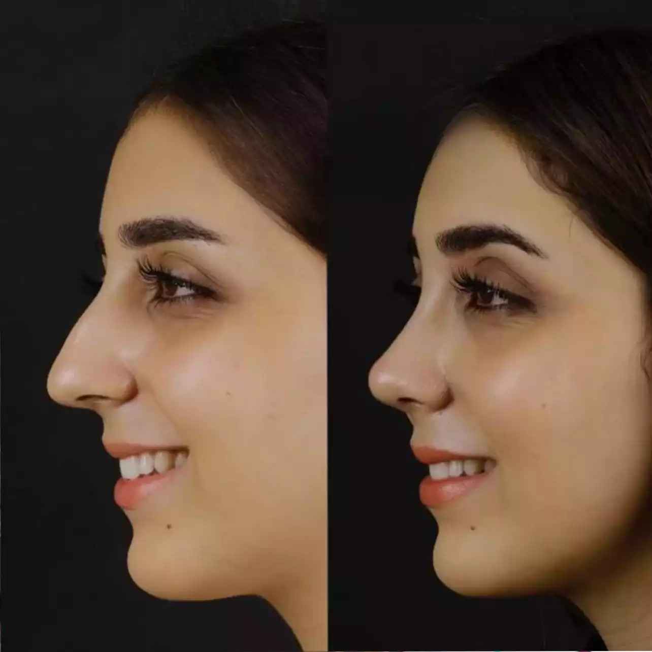 Best Septoplasty Surgeon in Dubai: Medical Excellence in Practice - Newsglo Septoplasty in Dubai