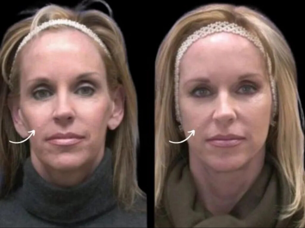 sculptra fillers