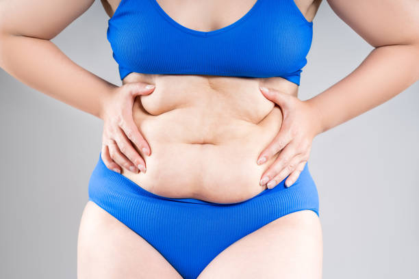 How Does Tummy Tuck Surgery Compare to Liposuction?