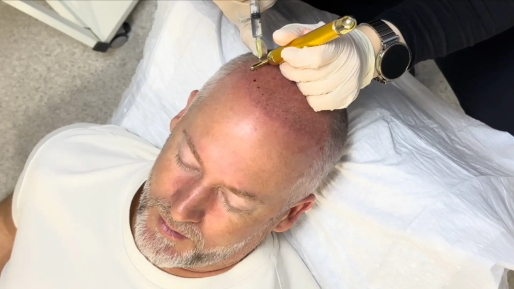 How Exosome Therapy Cost Fits Hair Loss Plans