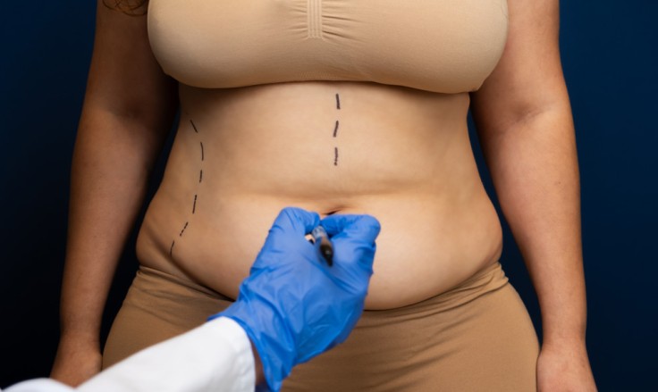 How Mini Abdominoplasty Delivers Natural Results