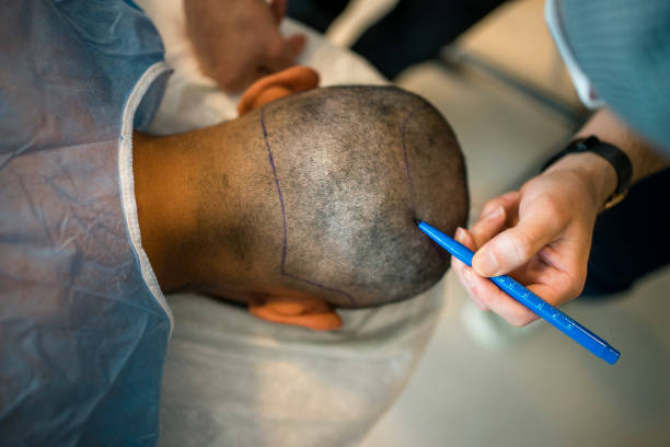 How Natural Will Crown Hair Transplant Look Afterwards