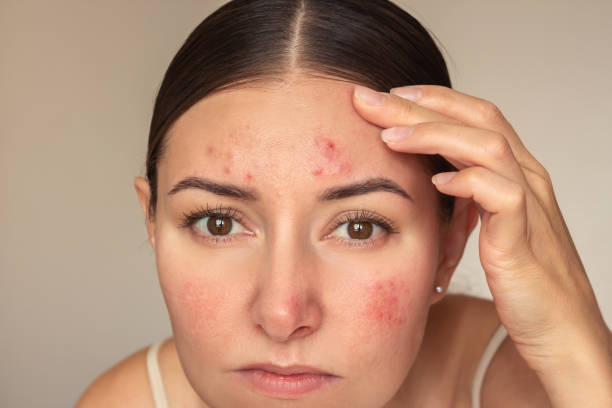 How to Maximize Results From Professional Acne Treatment - Newsglo How to Maximize Results From Professional Acne Treatment