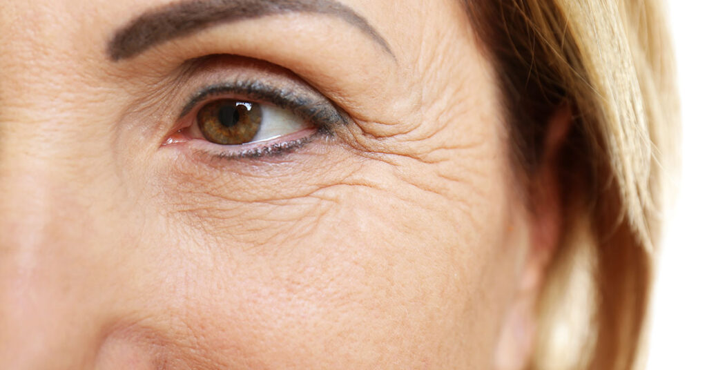 Is Fine Lines and Wrinkle Removal Long Lasting