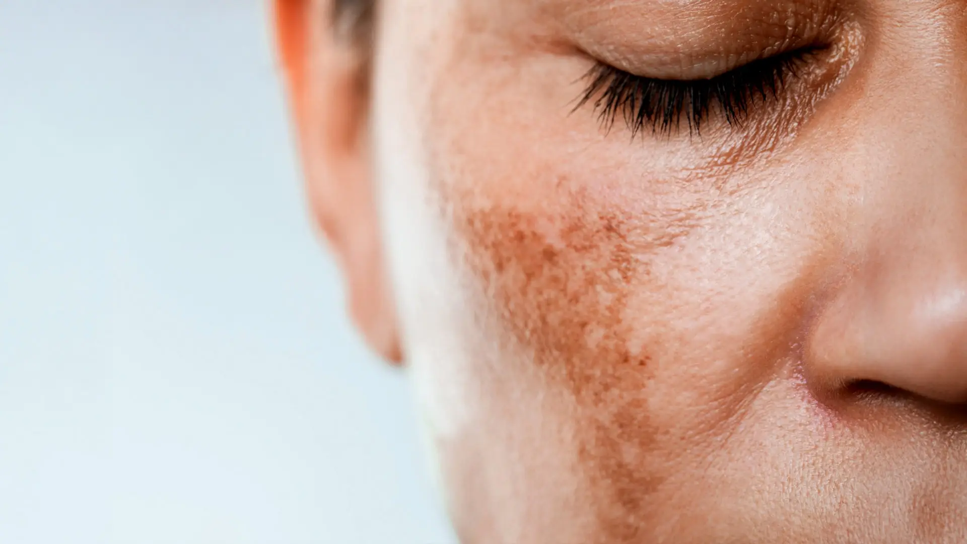 Is Melasma Treatment Painful or Comfortable