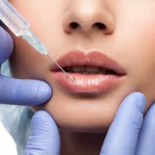 Lip Fillers for a Refined and Polished Appearance