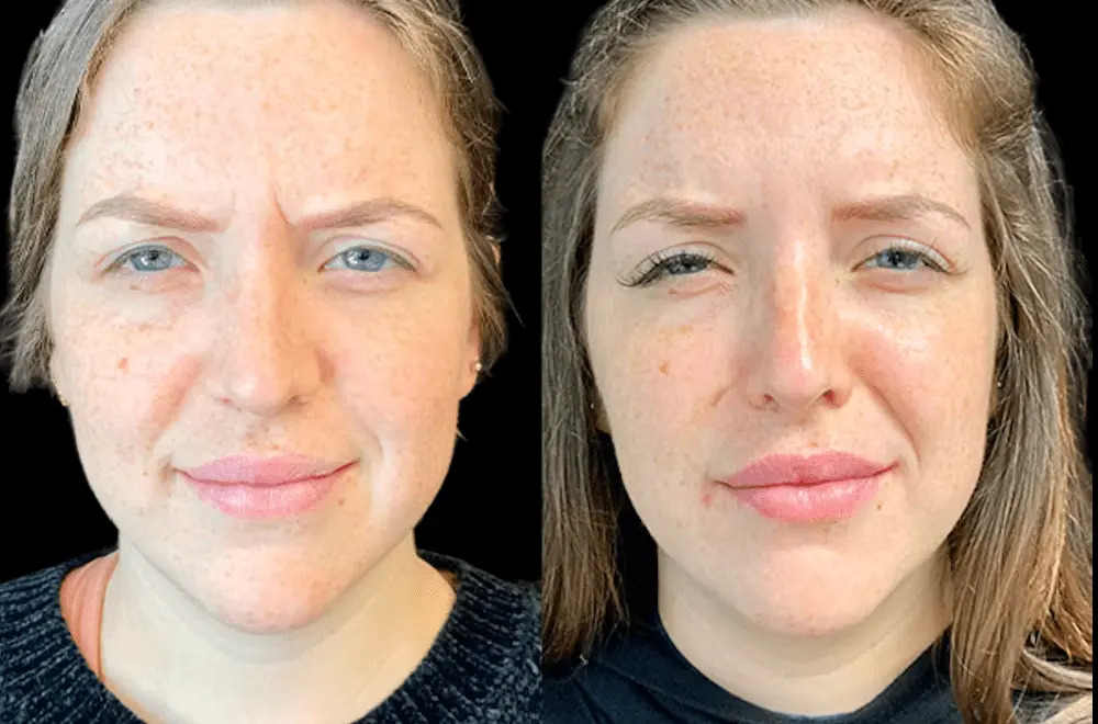 Best Plastic Surgeons in Dubai Specializing in Facial Botox Treatments - Newsglo Botox in Dubai