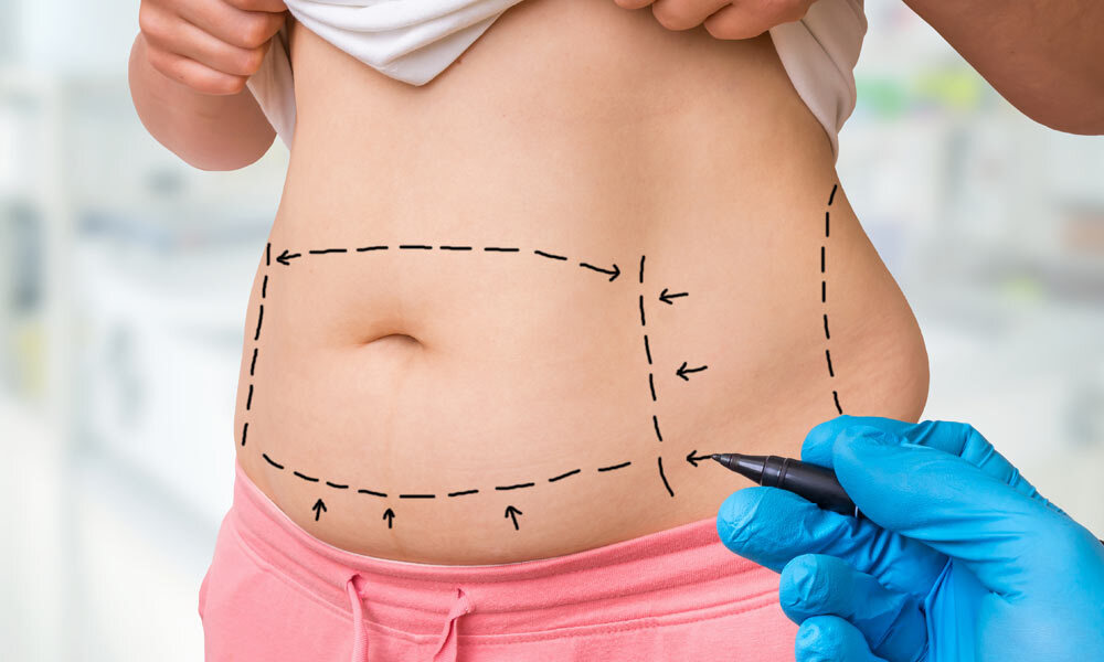 Refined Body Contouring with Mini Abdominoplasty