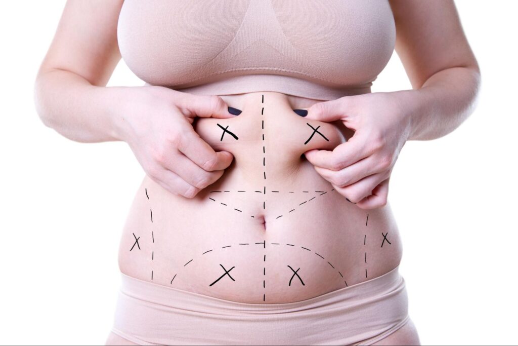 What Makes Vaser 4D Liposuction Different From Other Lipo