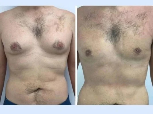 Gynecomastia in Dubai: A Reliable Way to Address Male Breast Tissue - Newsglo Gynecomastia in dubai