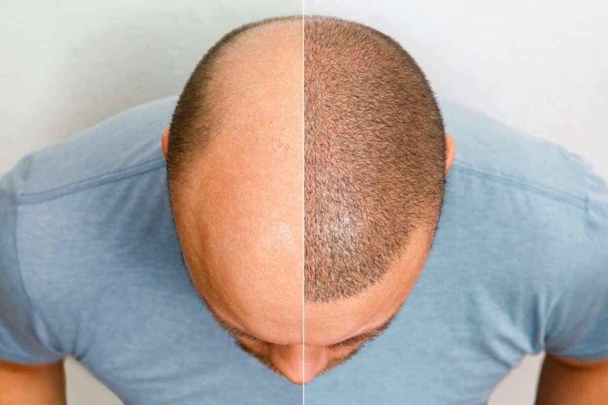 Hair Transplant Mistakes to Avoid: Expert Advice - Newsglo