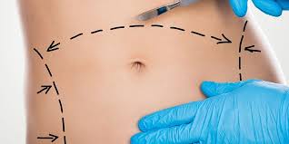 Fat Transfer in Dubai